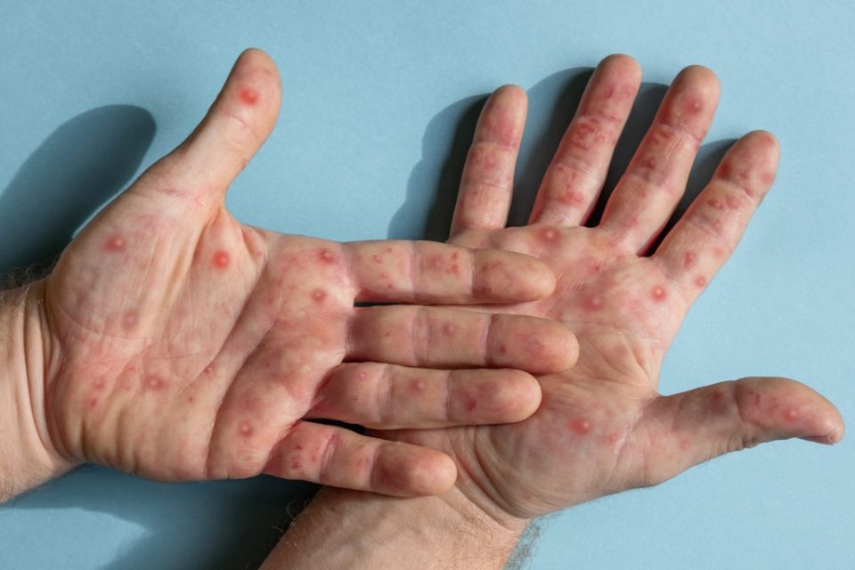 Во Белград пријавена епидемија на мали сипаници