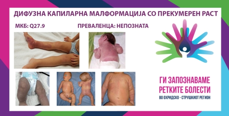 „Ги запознаваме ретките болести“ – Дифузна капиларна малформација со прекумерен раст