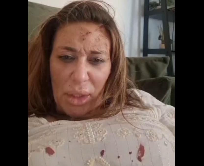 Крвава и модра: Ана Николиќ покажа колку е претепана од партнерот, ова е причината за расправијата (ВИДЕО)