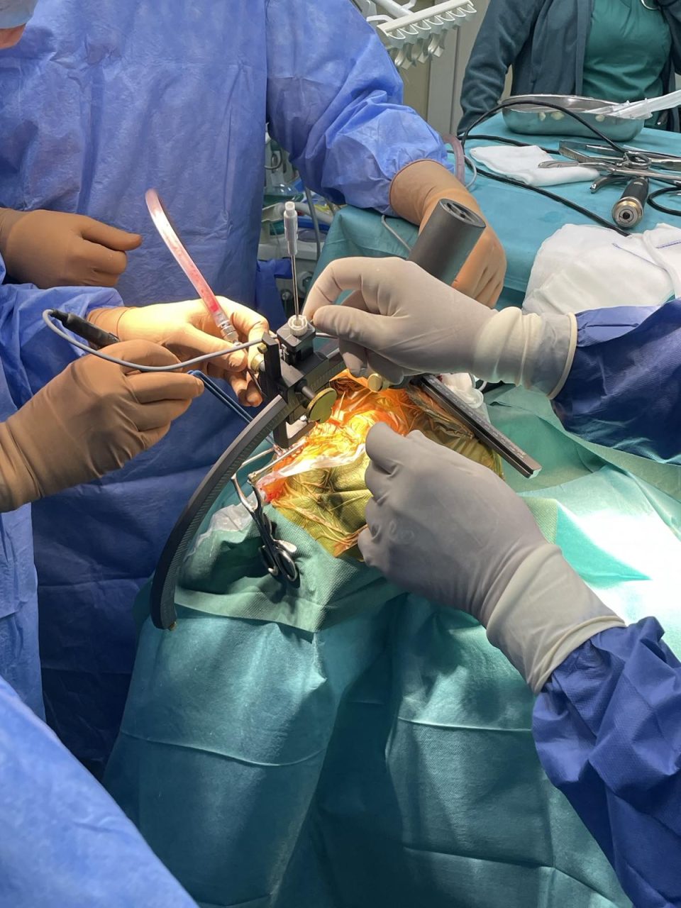 На Клиниката за неврохирургија во Скопје првпат се изведе операција на мозок со помош на системот за стереотаксија