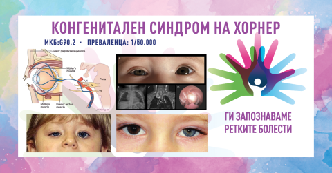 Ретки болести: Конгенитален синдром на хорнер