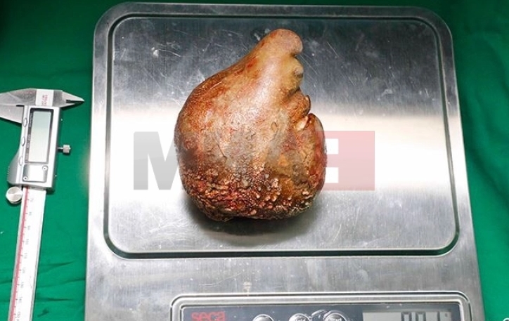 Научници открија бактерии во бубрежни камења