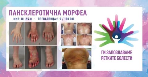 „Ги запознаваме ретките болести“: Пансклеротична морфеа