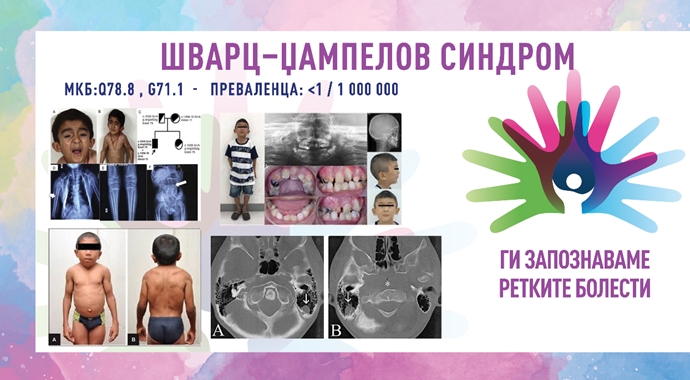 Ги запознаваме ретките болести: ШВАРЦ–ЏАМПЕЛОВ СИНДРОМ