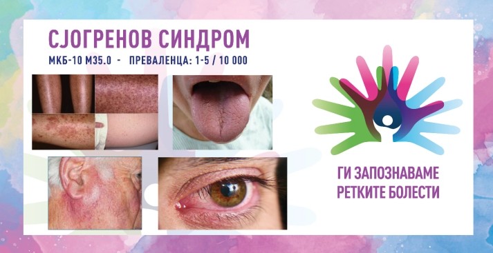 „Ги запознаваме ретките болести“: Сјогренов синдром